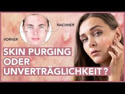 Erstverschlimmerung Skin Purging Fur Reine Haut Faces Of Fey