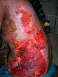 Since nerve endings are destroyed along with the dermis, these wounds are typically painless. Https Ispub Com Ijs 21 2 5354