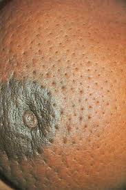 One breast that looks different from the other. Aproko Doctor On Twitter Take A Good Look At The Skin Surrounding The Nipple Look At The Nipple Also It Is Called Dimpling Of The Skin Like The Skin On An Orange