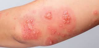 Image result for Skin Infection