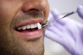 Dental veneer diagnosis & planning. Porcelain Dental Veneers Treatment Recovery Cost Updated 2019