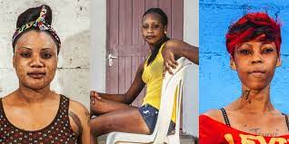 This happens when coral polyps expel their symbiotic algae (zooxanthellae) as the result of some kind of stress event. Skin Bleaching How And Why These Black Women Bleach Their Skin