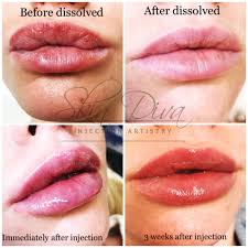 Maybe you would like to learn more about one of these? Lip Injections Lip Injections Perfect Lips Injections Botox Fillers