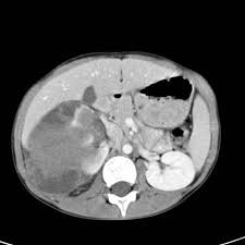 We did not find results for: Wilms Tumor Radiology Reference Article Radiopaedia Org