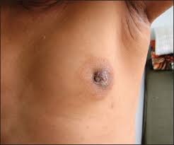 Most male breast cancers are diagnosed when a man finds a lump on his chest. 13 Surprising Symptoms Of Male Breast Cancer You Should Never Ignore Page 2