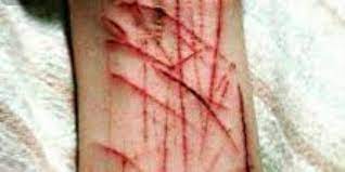 كاتنج تشريح اليد بالموس بنات. Ø§Ù†ØªØ´Ø±Øª ÙƒØ§Ù„Ù†Ø§Ø± ÙÙŠ Ø§Ù„Ù‡Ø´ÙŠÙ… Ø§Ù„ÙƒØ§ØªÙŠÙ†Ø¬ Ù…ÙˆØ¶Ø© Ø¨ÙŠÙ† Ø§Ù„Ù…Ø±Ø§Ù‡Ù‚ÙŠÙ† ÙˆØªØ±ÙˆØ¬Ù‡Ø§ Ù…ÙˆØ§Ù‚Ø¹ Ø§Ù„ØªÙˆØ§ØµÙ„ Ø§Ù„Ø§Ø¬ØªÙ…Ø§Ø¹ÙŠ ØµÙˆØª Ø§Ù„Ø£Ù…Ø©