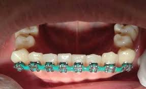 Today we're going to make fake braces, she tells her youtube viewers. Howard Farran On Twitter Always Make Sure The Person Doing Your Braces Knows What They Are Doing Do It Yourself Braces Is Never A Good Idea