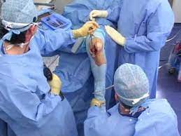 L'arthrose partielle du genou et prothèse uni compartimentale. Prothese Unicompartimentale Du Genou Youtube