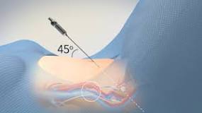 Abdominal Entry in Laparoscopic Gynecologic Surgery - TVASurg ...