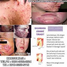 Sebelum mengetahui cara menghilangkan jerawat batu, simak dahulu beberapa hal yang harus mengetahui mengenai masalah kulit yang satu ini. Cara Alami Hilangkan Bekas Jerawat Di Wajah Cara Menghilangkan Jerawat Nanah Dalam Semalam Secara Alami