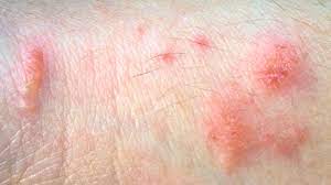 The leaves can vary from smooth to being lobed (looking like a pair of mittens) or toothed (pointed). Poison Ivy Rash Pictures Remedies Prevention More