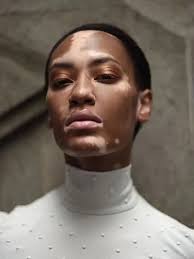 Menderita Vitiligo, Amy Deanna Berhasil Jadi Model yang Mendunia