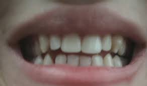 Lamina diş fiyatları kaç tane dişe uygulandığına bağlı olarak değişebilir. Dis Dolgusu Yaptiranlar