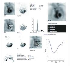 Image result for Nuclear Ventriculogram