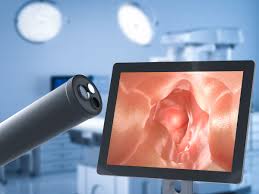 Image result for Colon Cancer Screening with Colonoscopy