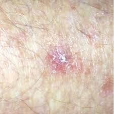 We include products we think are useful for our readers. Squamous Cell Carcinoma Pictures Scc View Our Library