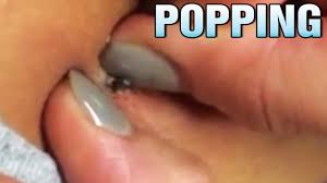 Sometimes, the ingrown hair is visible in the swollen red bump. Zit Blackhead And Ingrown Hair Compilation Pimple Popping Videos