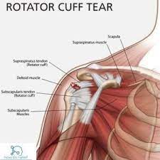 In addition to shoulder dislocations, other common injuries include rotator cuff tendon tears and broken bones including the humerus and collar terry gc, chopp tm. Muscles Anatomy Physiology Health Fitness Training Muscle Bone Rotator Cuff Injury Rotator Cuff Surgery Rotator Cuff Tear