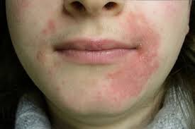 Image result for dermatitis contacta toxica