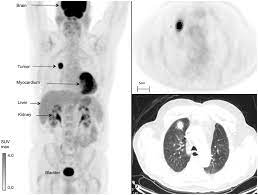 Non Small Cell Lung Cancer Fdg Pet Ct Imaging Features A Three Download Scientific Diagram