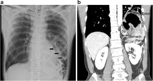 How can bowel habits indicate colon cancer? Bochdalek Hernia In An Adult Two Case Reports And A Review Of Perioperative Cardiopulmonary Complications Springerlink