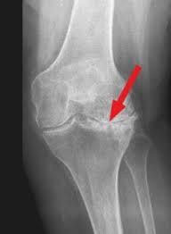 Arthrose Des Knies Gonarthrose Diagnose Und Therapie Priv Doz Ddr Christian Albrecht Knie Und Knorpelspezialist