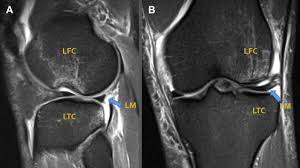 Medial epicondyle apophysitis, often called little league elbow, is the most common injury affecting young baseball pitchers whose bones have not yet stopped growing. Technique For Treatment Of Subchondral Compression Fracture Of The Lateral Femoral Condyle Associated With Acl Tear Arthroscopy Techniques