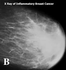 The discoloration can look like a bruise, so you might shrug it off as nothing serious. Inflammatory Breast Cancer Moose And Doc