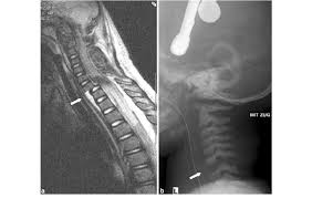 We will see how we can use collections to manipulate a group of models and how we can use restul api to easily fetch and save collections. A T2 Weighted Mri Images After The Spinal Cord Injury Was Detected Download Scientific Diagram