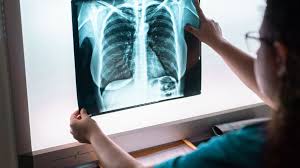 While it's true that 90 percent of lung cancer cases are smoking related, 10 percent come from other causes, and that number is even higher in utah at 30 percent. 6 Myths About Lung Cancer Debunked