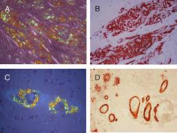 Congo red staining is usually used in diagnosing amyloidosis, a pathology characterized by the storage of in our work, studying a sudden death caused by cardiac amyloidosis and diagnosed only with postmortem exams, we present a modified congo red staining used with the purpose to. Cardiac Amyloid In Ssa A B And Cerebrocascular Amyloid In Caa C Download Scientific Diagram