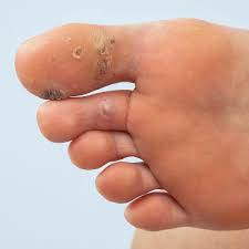 Image result for verruca