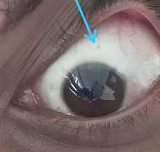 Image result for nevus sclerae