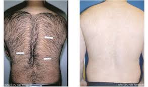 It may take multiple treatments to remove unwanted hair completely, and permanent hair removal is not always. Laser Hair Removal For Men