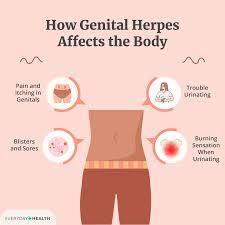Image result for genital herpes