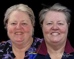 Smile improvement procedure completed