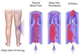 Deep Vein Thrombosis Dvt Ucla Pulmonary Vascular Disease Program Los Angeles Ca