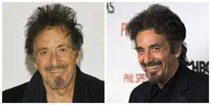 Grazie al fatto che la chirurgia estetica dei . I Trapianti Di Capelli Delle Star