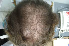 Protecting your scalp in summer. Thinning Hair At The Frontal Scalp And Crown Clinical Advisor