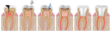 Root Canal Therapy in St. Louis