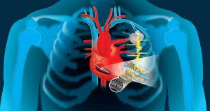 Image result for Phosphorus Replacement