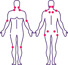 Dolor muscular extendido, alodinia, fibromialgia, trastornos de la piel, sensación de cosquilleo en la. Fibromialgia O Que E E Como Lidar Saude Em Pauta Unimed Mercosul