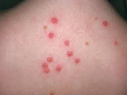 Flea Bites That Look Like Mosquito Bites Pin On Home