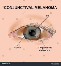 Image result for conjunctival melanoma