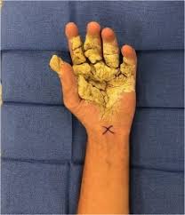 Image result for scabies norvegica