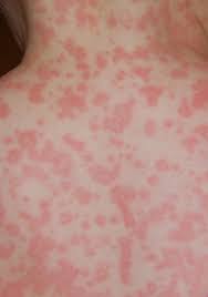 Amoxicillin rash is more common in children with girls being more likely to develop one than boys. Antibiotic Allergy Or Just A Rash Quest For Health Kc