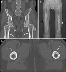 Sclerotic Bone Lesions Caused By Non Infectious And Non Neoplastic Diseases A Review Of The Imaging And Clinicopathologic Findings Springerlink