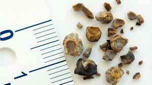 Treatment For Kidney Stones Niddk