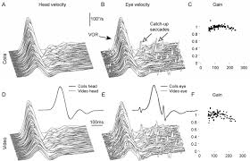 Image result for Horizontal Head Impulse Test