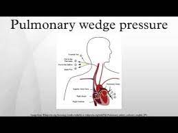 Scratcher joined 11 years, 1 month ago germany. Pulmonary Wedge Pressure Youtube